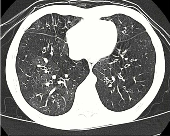 image of popcorn lung