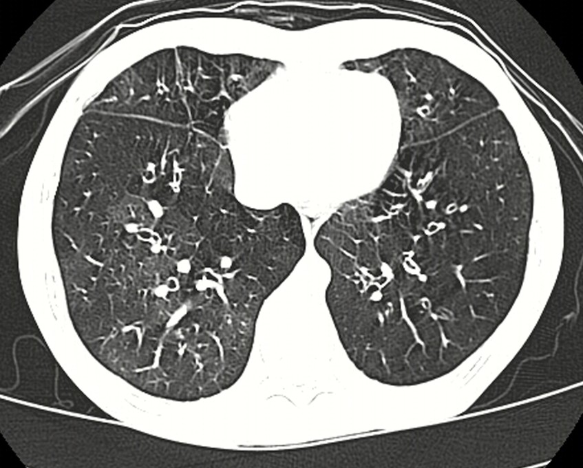popcorn lungs